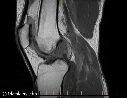 MRI of torn ACL